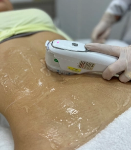 Ultrassom Microfocado Corporal